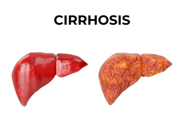 A túlzott alkoholfogyasztás vagy a súlyos zsírmáj betegség a májszövet károsodásához, májzsugor (májcirrhosis) kialakulásához vezethet. A máriatövis védi a májsejteket, elősegíti a károsodott májszövet regenerációját. Hatóanyaga, a szilimarin képes csökkenteni, gátolni a májfibrózist.
