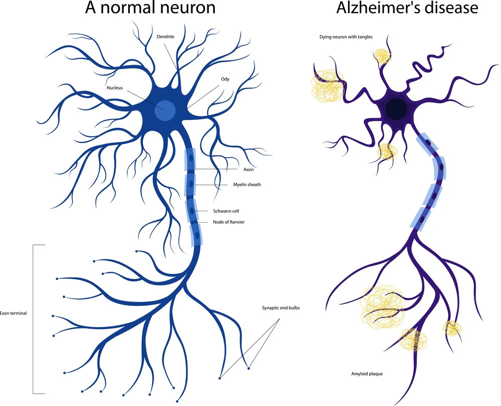 Egymás mellett elhelyezett neuronábrák, amelyek egy normál neuront, valamint az Alzheimer-kórban érintett, kötegeket és amiloid plakkokat tartalmazó neuront mutatják be.