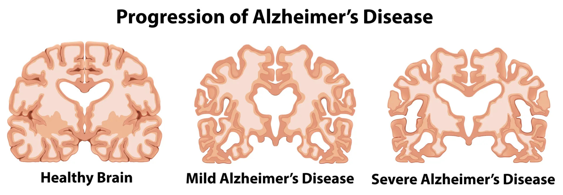 Három stilizált agyi keresztmetszet, „egészséges”, „enyhe Alzheimer-kór” és „súlyos Alzheimer-kór” felirattal.