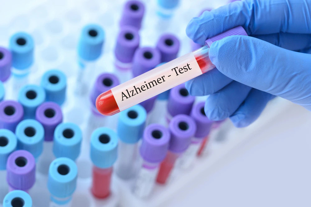 Kesztyűs kéz tart egy „Alzheimer-Teszt” feliratú, piros vérvételi csövet számos színes kémcső között.