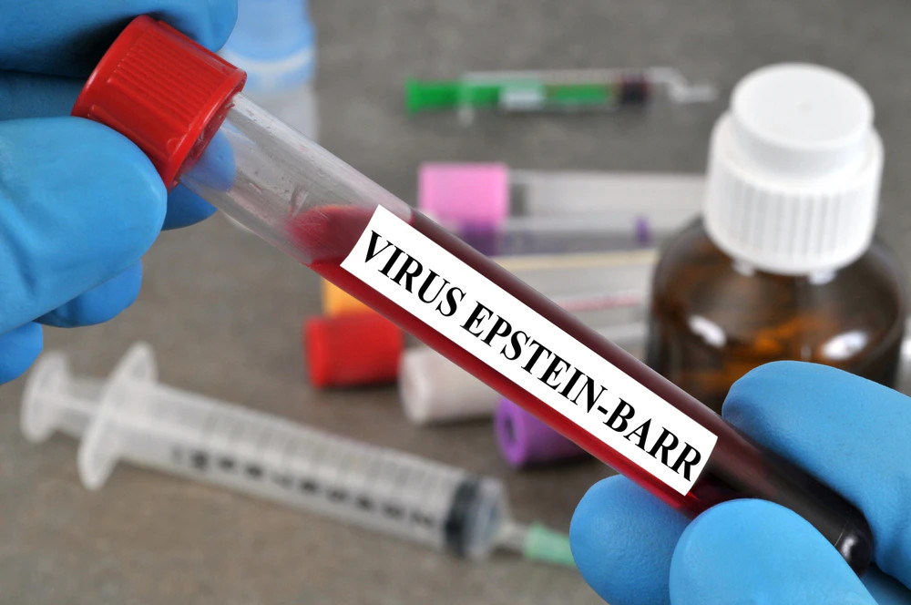 Kesztyűs kéz egy „VIRUS EPSTEIN-BARR” feliratú, piros kupakos fiolát tart; a háttérben elmosódott laboratóriumi eszközök láthatók.